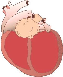 Cœur présentant une CMD